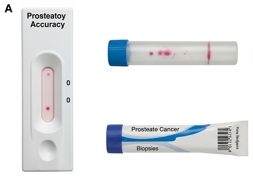 یه آزمایش ادرار ساده، سرطان پروستات رو با دقت فوق‌العاده‌ای تشخیص میده